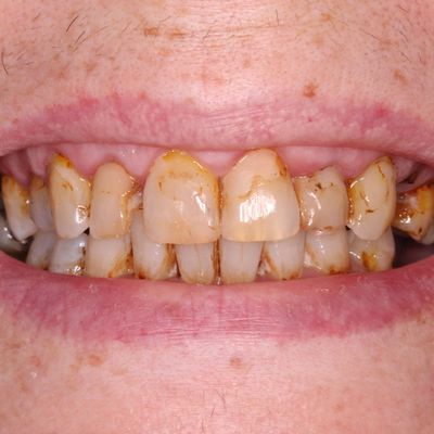 Dental Veneers - Smile 15 before